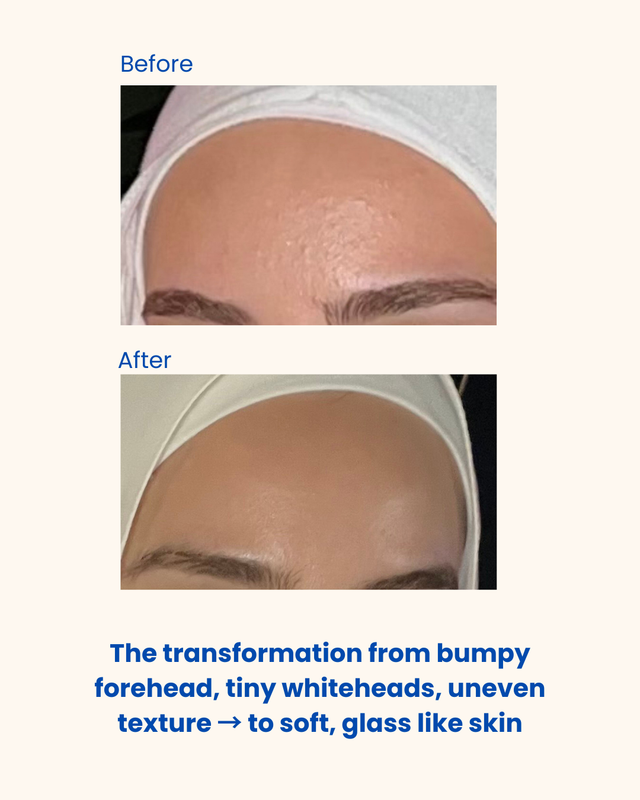 Acne fighting trio